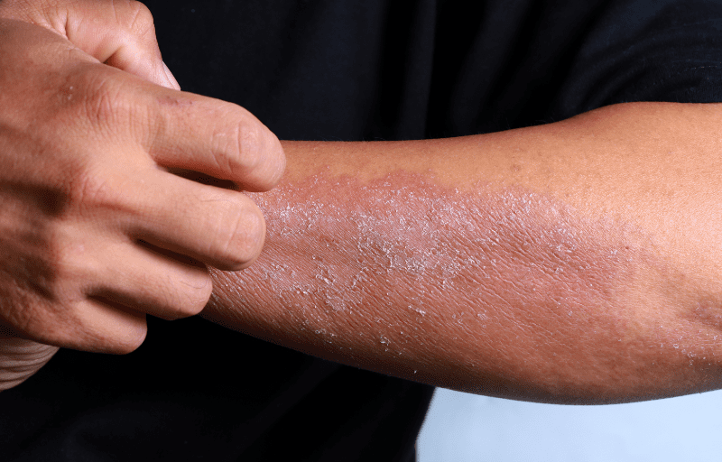 Eczema in adults