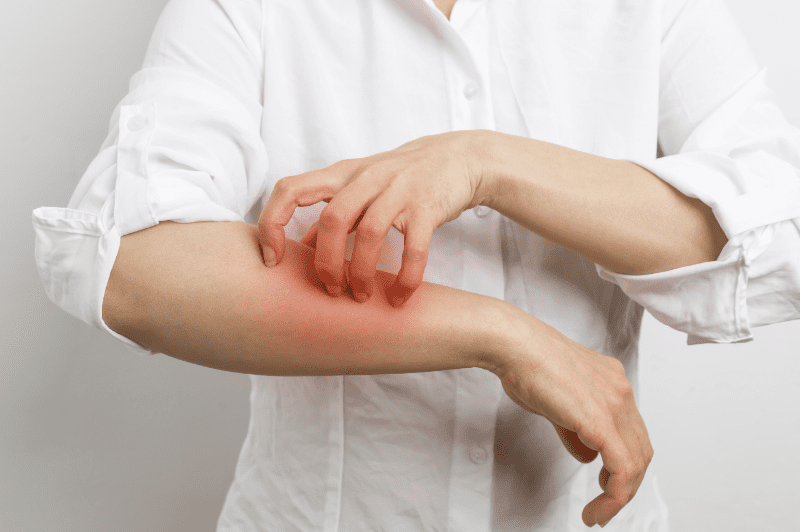 Symptoms of food allergy
