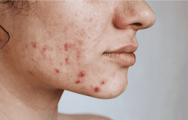 acne skin conditions